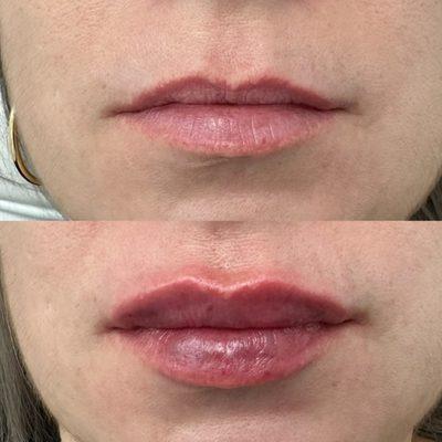 Lip fillers