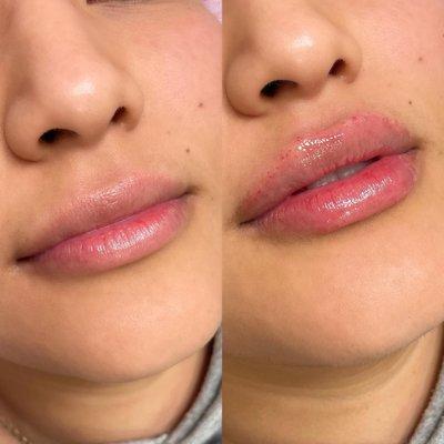 Hyaluron Pen Lip Filler