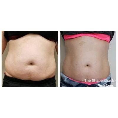 6 sessions of Laser Lipo Sculpt, Ultrasonic Cavitation, & Therma Lift 
 *Results may vary