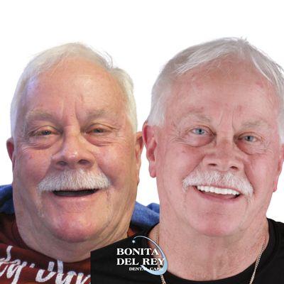 From dentures to a long lasting permanent smile with dental implants!