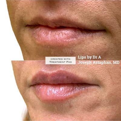 Lip Filler