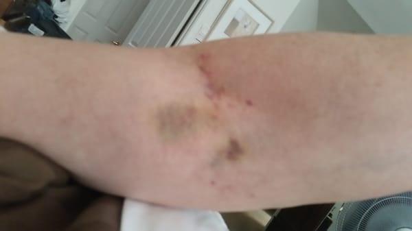 Compliments of the ER. Over a dozen attempts to get an IV in the arm.