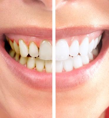 Professional Teeth Whitening Thornton Colorado