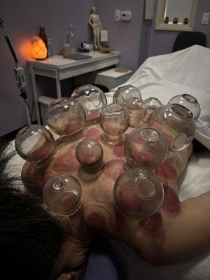 Fire cupping