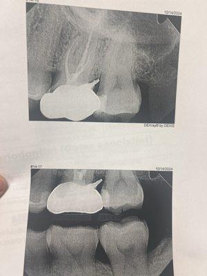 Crown that didn't fit well n metal out n bother my gum . My dentist also mention that a lot of ppl complaint to this place .