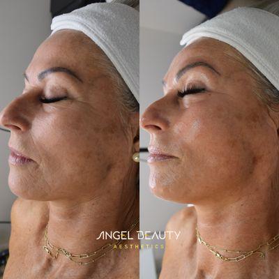 Our Face Lift With our Biotherapeutic Microcurrent l.