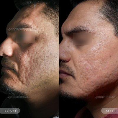 Before and after results of a combination acne scar treatment performed by Dr. Qazi!