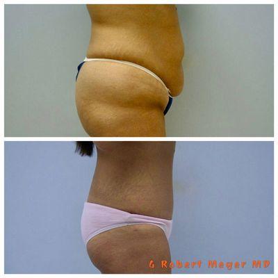 Abdominoplasty with liposuction of the flanks.