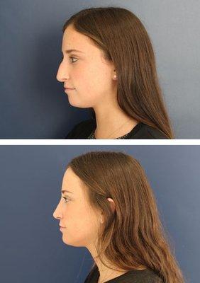 Rhinoplasty Before and After for a straighter ridge