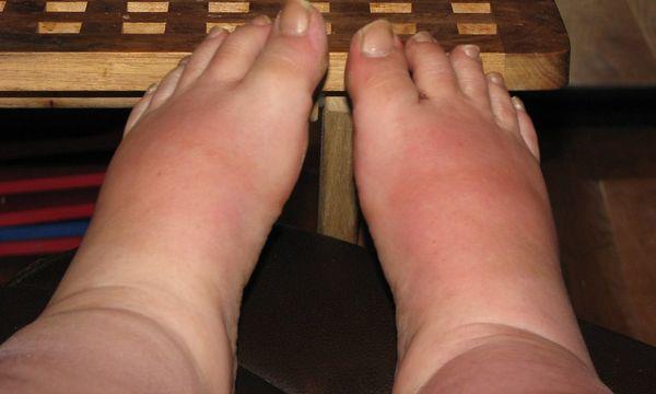 I treat lymphedema and chronic swelling