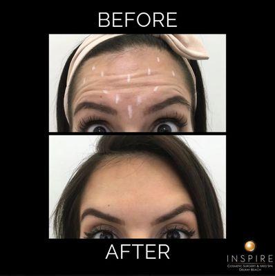 Before and after Botox Treatment to reduce forehead wrinkles at Inspire Cosmetic Surgery & Med Spa.