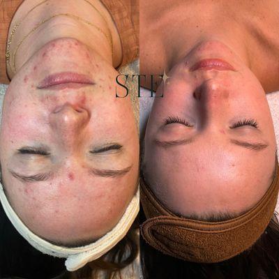 Before and after a series of facial treatments over about a year time span