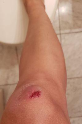 Skinned knee