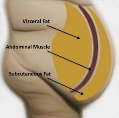 How much fat can we safely remove,? We can only remove the subcutaneous fat. Visceral fat can only be reduced with diet and exercise.