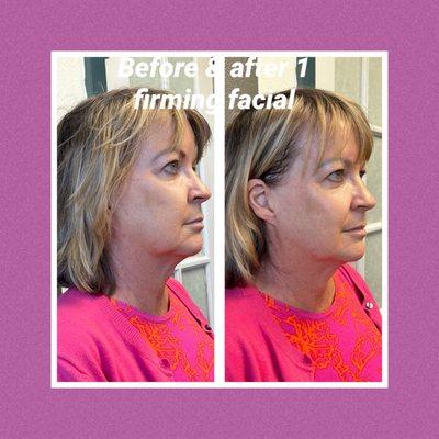 Firming and Tightening Facial