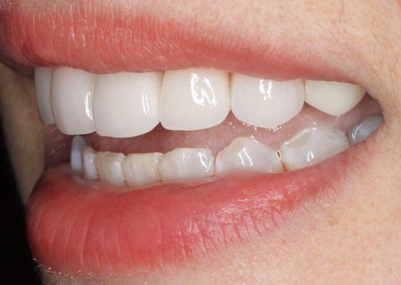 Smile makeover with veneers