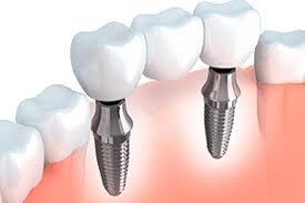 Implant bridge for multiple missing teeth.