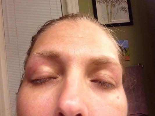 Kind of hard to see but the red marks where they waxed my eyelids 10 hours after the waxing. Ouch