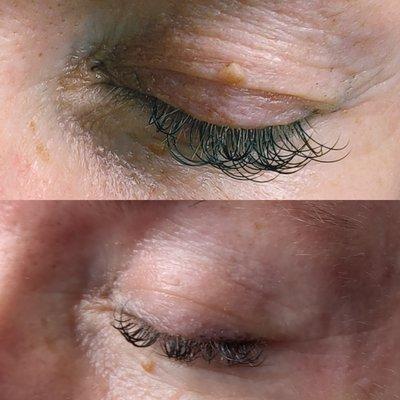 Non-surgical eyelid lift. The skin tightening treatment has little downtime. And is very effective with as little as one treatment.