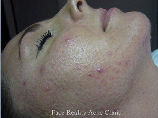 Before Treatment from Essentials for Clear Skin - www.essentialsforclearskin.com