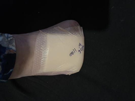 My foot still healing. Toes amputated October 27, 2023. Today is April 25, 2024.