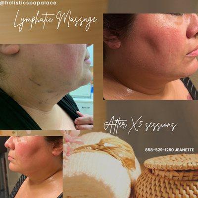 Lymphatic drainage postop package for chin lipo