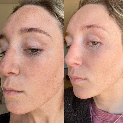 Before/after Photofacial