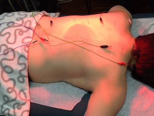 Acupuncture with electric stimulation help to improve blood circulation,reduce muscle pain, release anxiety, improve sleep, balance immune