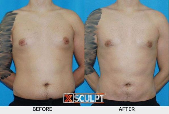 Chest liposuction with breast gland removal & hi-definition liposuction of abdomen, flanks and back. 2mos post op