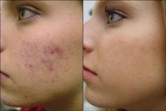 This clear skin was created with the PCA Skin Sensi Peel - client bought a series and home care :) Come get your face clear! www.jazskin.com