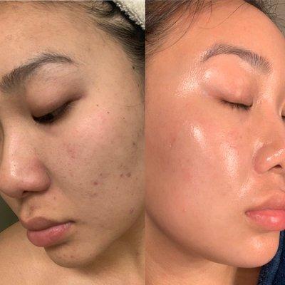 before/after. Last treatment was nanoneedling. Skin treatment curated by Janny.