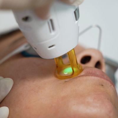 Facial laser treatments