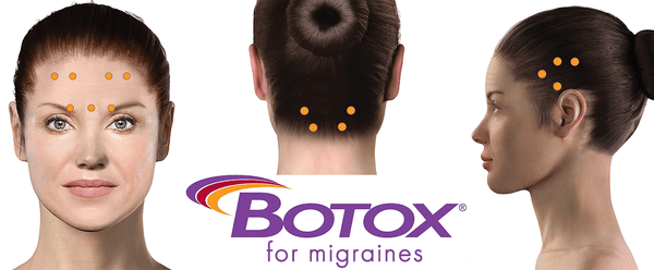 BOTOX® can also be used to treat chronic migraines by preventing headaches and migraines before they even start.