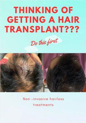 No expensive hair Transplant, no fake hair. Grow your own hair