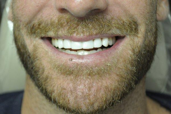 Actual Patient- 2018- After Cosmetic Bonded Veneers