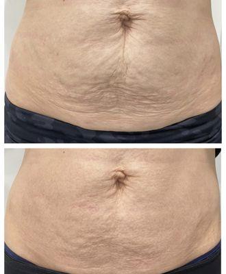 Before and after of the plasma fibroblast Skin Tightening treatment.