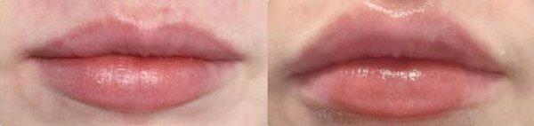 Before and immediately after filler was applied to this patients lips.