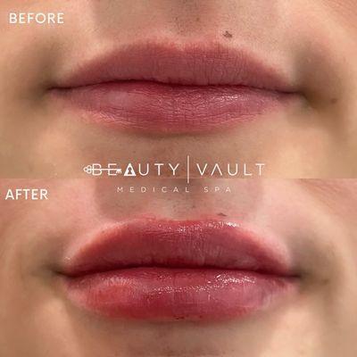 Lip Filler Before & After Beauty Vault Med Spa in West Hollywood, CA