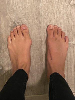 Right foot after healed bunion surgery, Left foot before bunion surgery