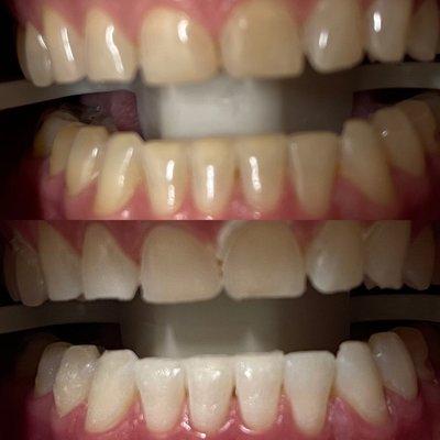 Zoom whitening before and after.