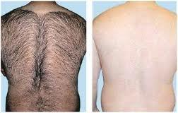 laser hair removal before and after