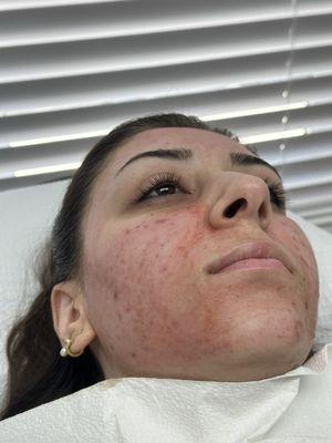 Full face microneedling with prp