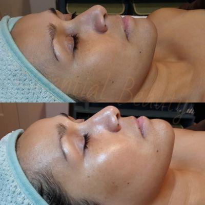 Before & after of the Oxygen Regenerative Peel