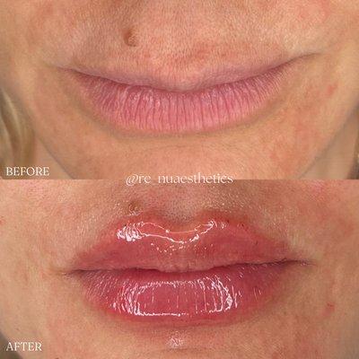 BEFORE & AFTER lip filler