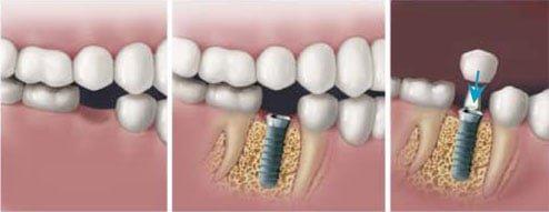 Dental Implants to Permanently Replace Missing or Broken Teeth