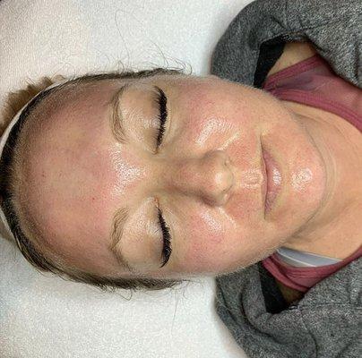 Post microneedling glow, this patients collagen will be working overtime to heal the micro punctures and fill in those fine lines