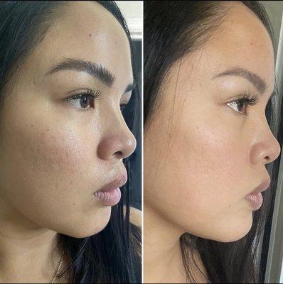 Micro-needling for texture / acne scarring