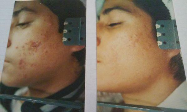 ACNE RESOLVE