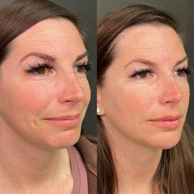 Full facial balancing with Sculptra and fillers