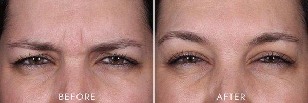 DAXXIFY before and after, lasts twice as long as Botox! One of the few local providers offering this product!!